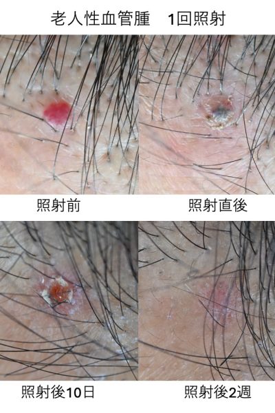 老人性血管腫　1回照射